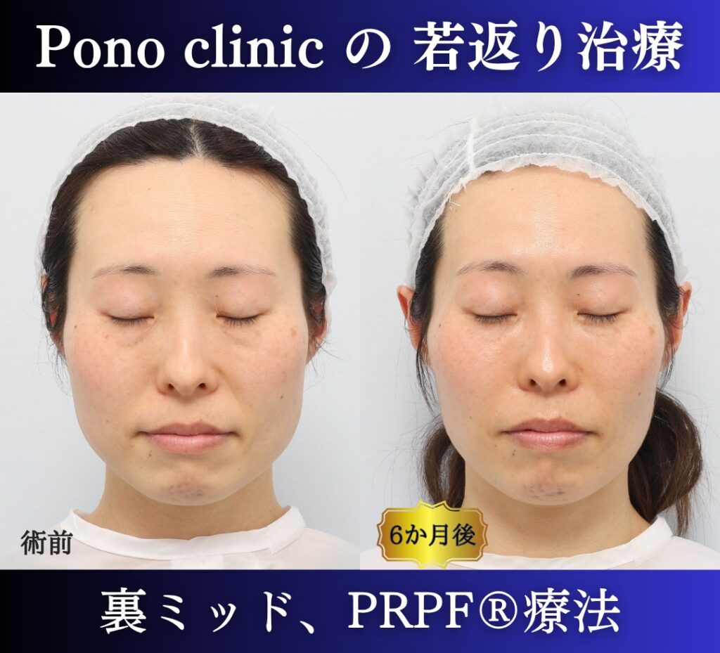 40代女性、目の下のクマ取り、裏ハムラ、ミッドフェイスリフト、法令線治療、しわ治療 (6)