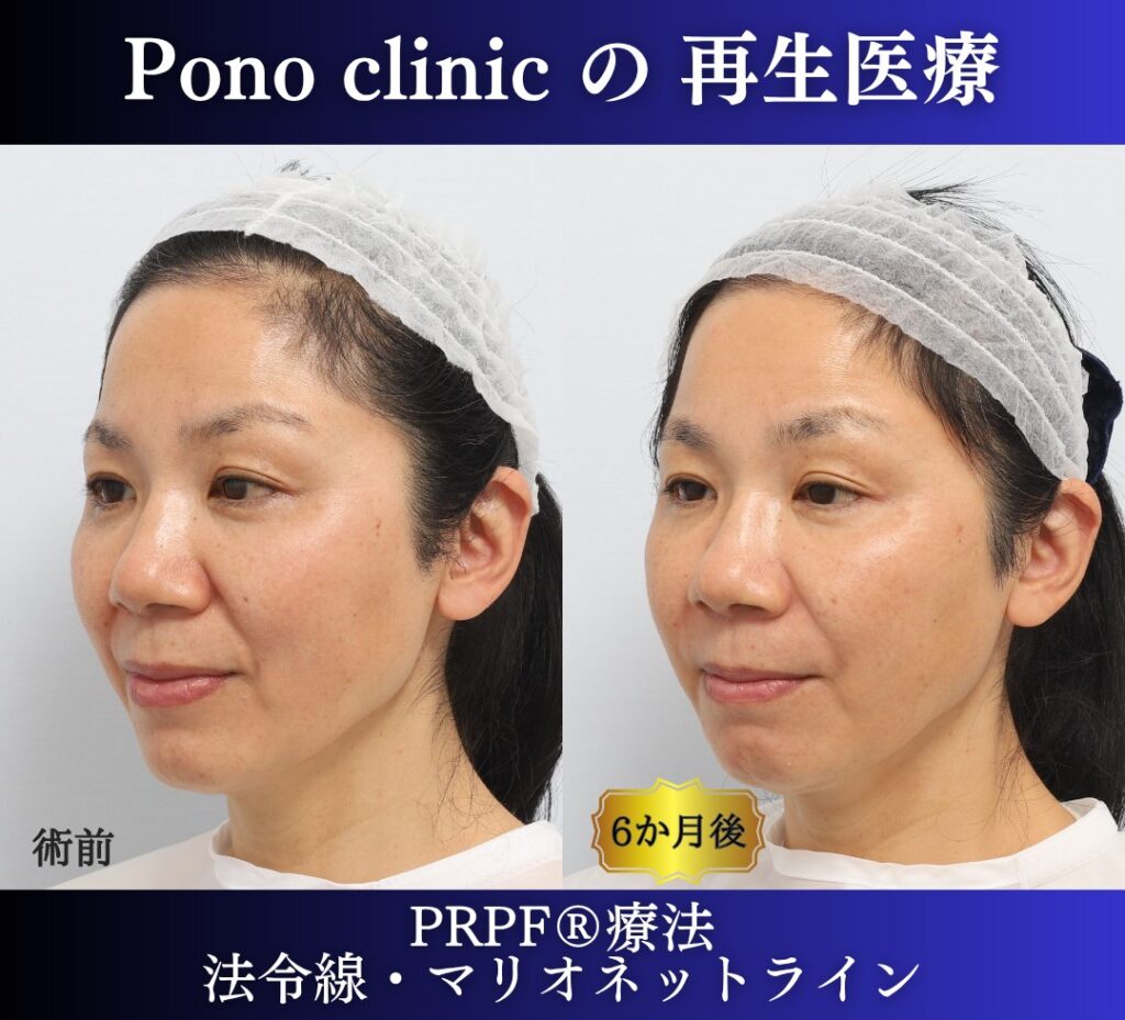 50代女性、しわ治療、法令線、マリオネットライン、PRPF療法 (2)