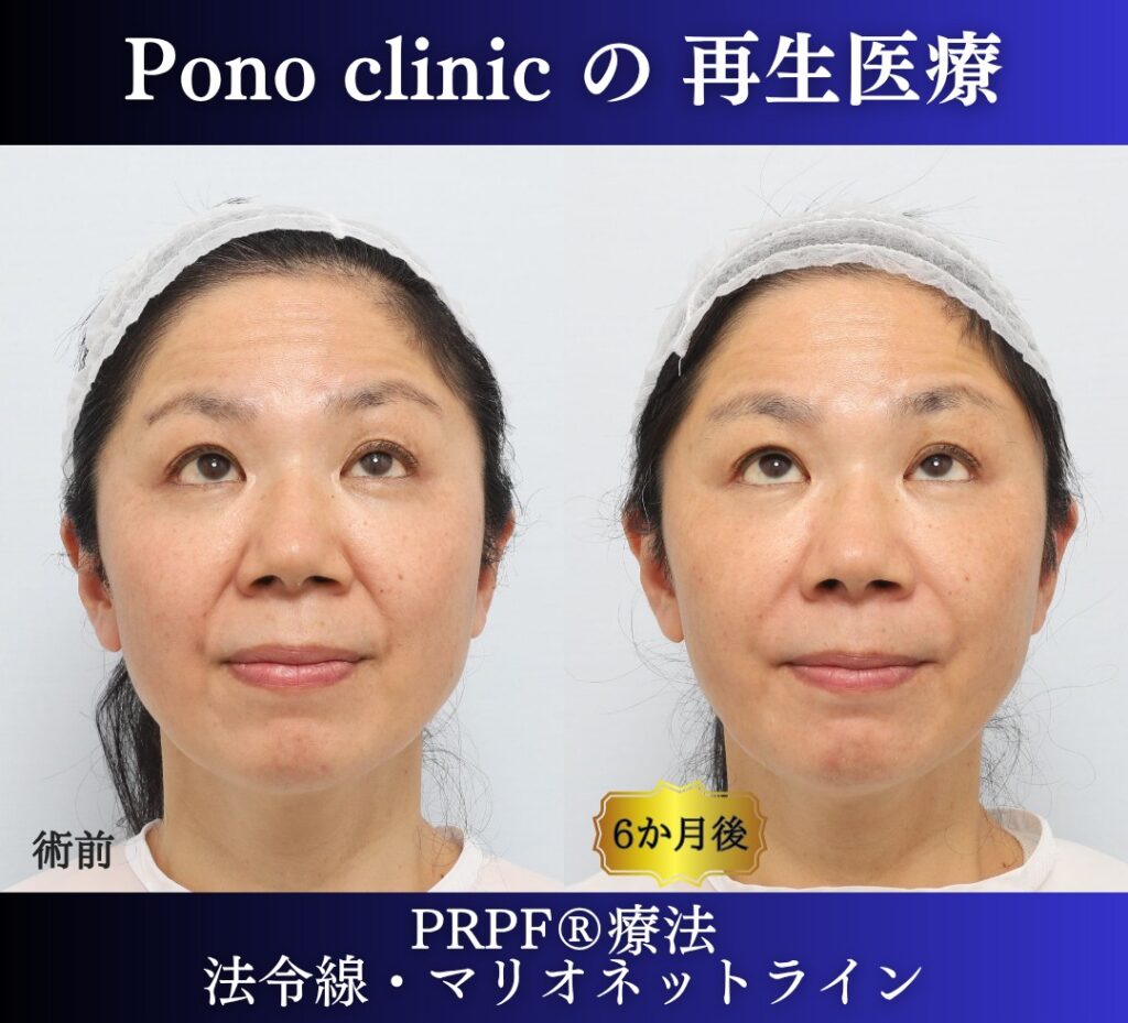 50代女性、しわ治療、法令線、マリオネットライン、PRPF療法 (3)