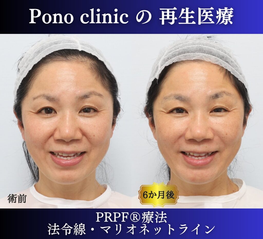 50代女性、しわ治療、法令線、マリオネットライン、PRPF療法 (4)