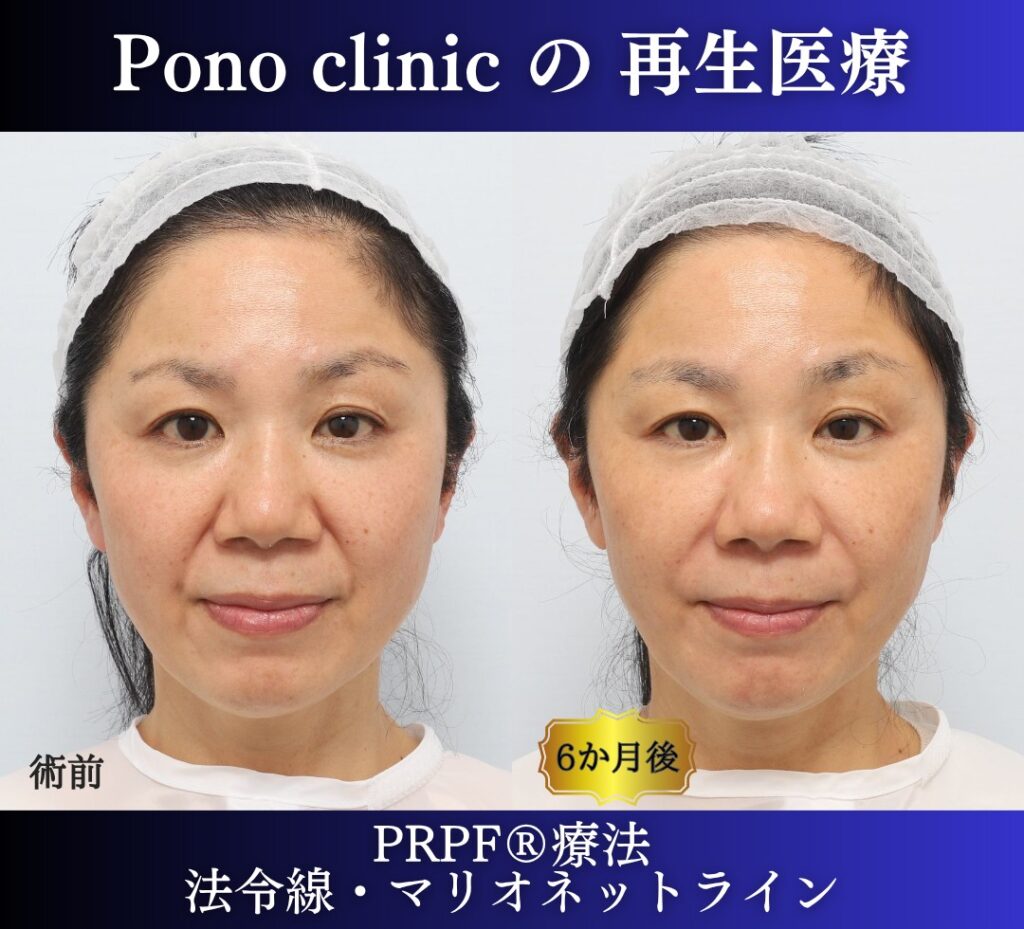 50代女性、しわ治療、法令線、マリオネットライン、PRPF療法 (5)