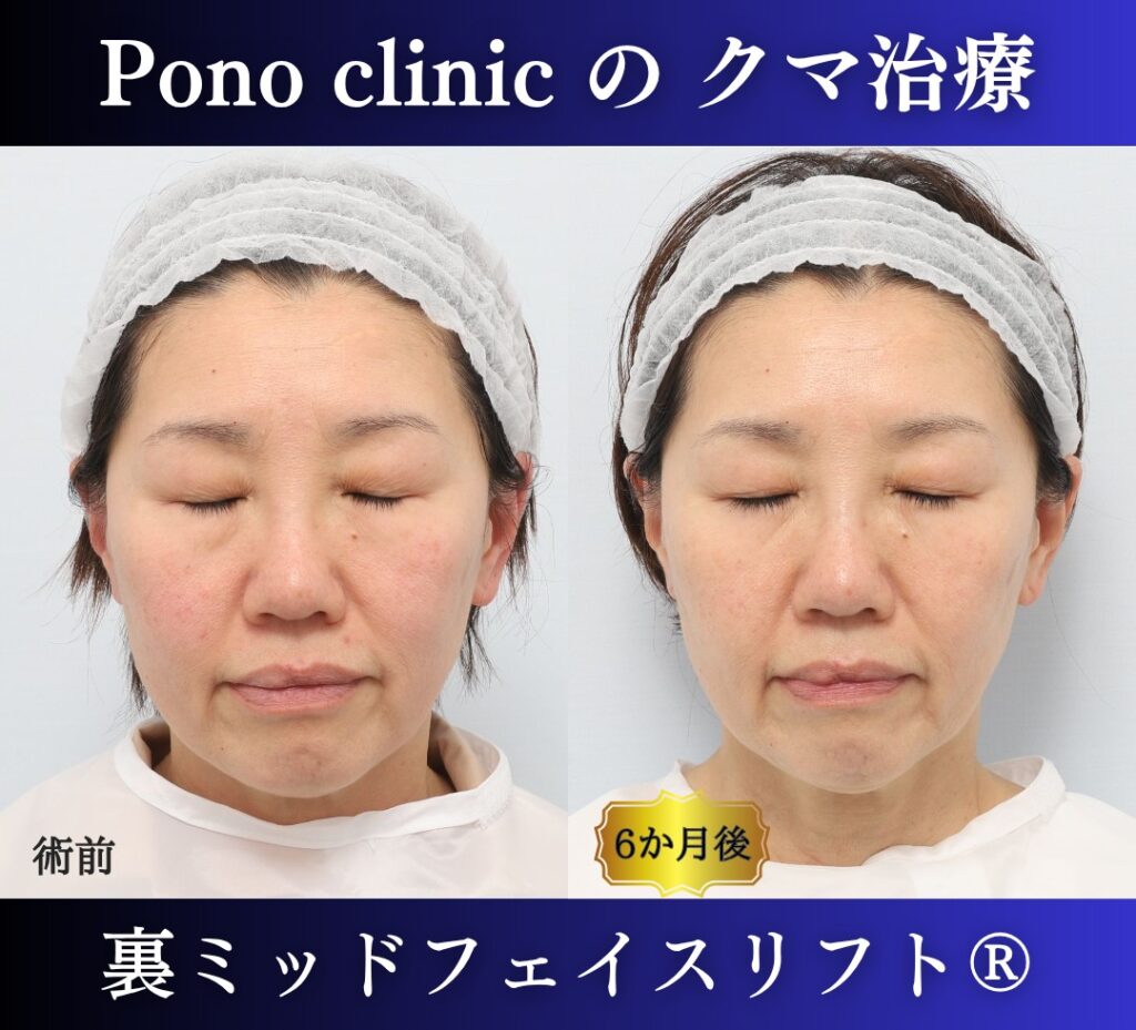 50代女性、目の下のクマ取り、裏ハムラ、ミッドフェイスリフト (5)
