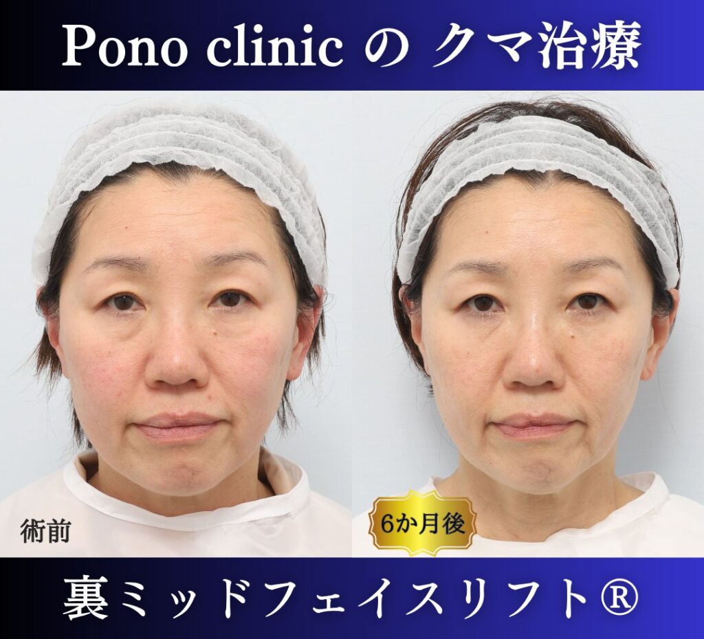 50代女性、目の下のクマ取り、裏ハムラ、ミッドフェイスリフト (6)