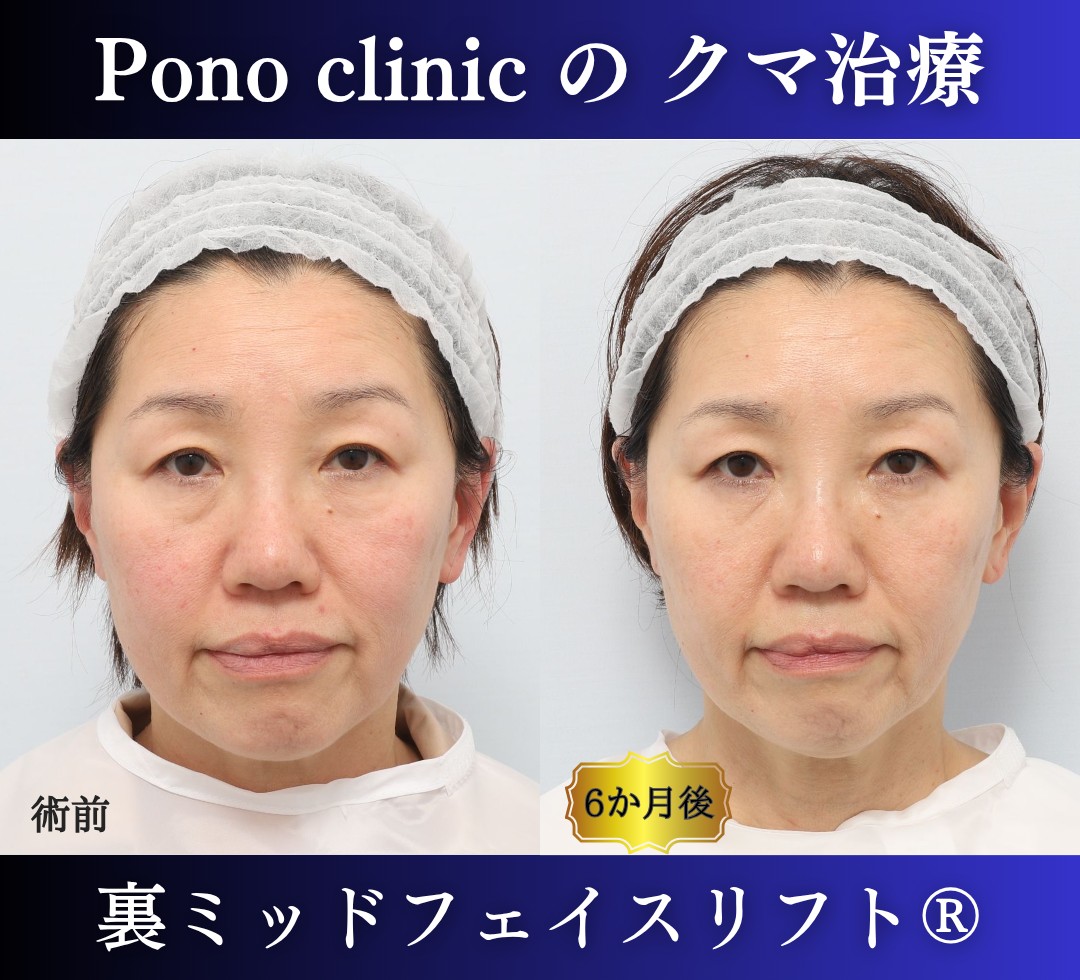 50代女性、目の下のクマ取り、裏ハムラ、ミッドフェイスリフト (6)
