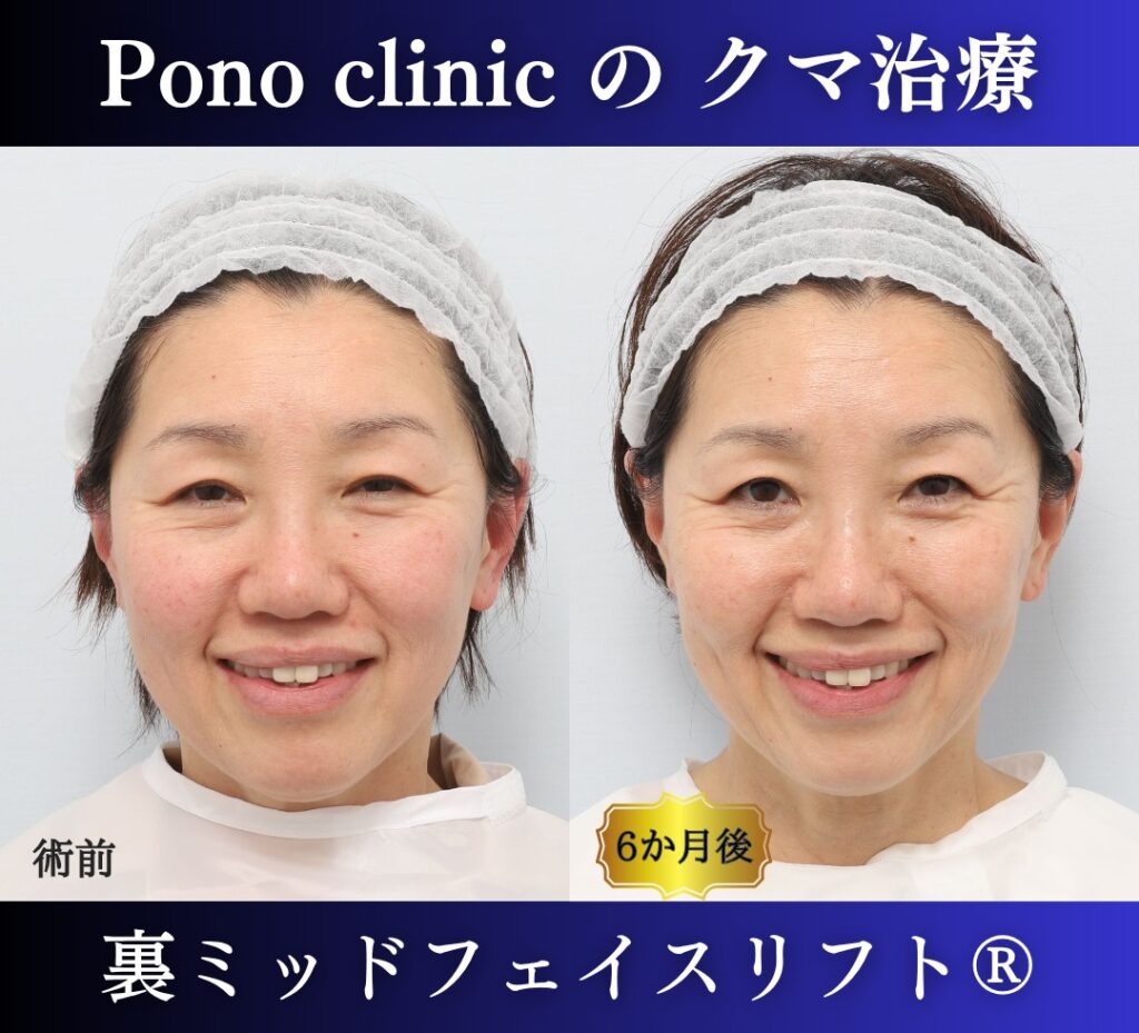 50代女性、目の下のクマ取り、裏ハムラ、ミッドフェイスリフト (7)